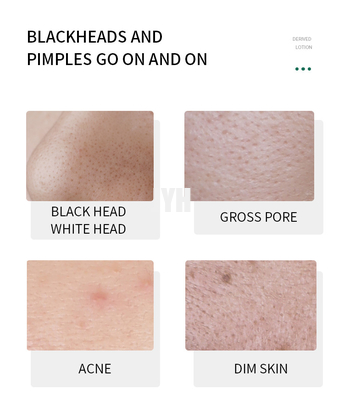 Soften Lackhead Derived Essence Face Serum Blackhead Remover Serum