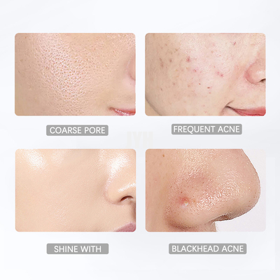 Salicylic Acid Facial Skin Toner 100ml Refershing Moisturizing