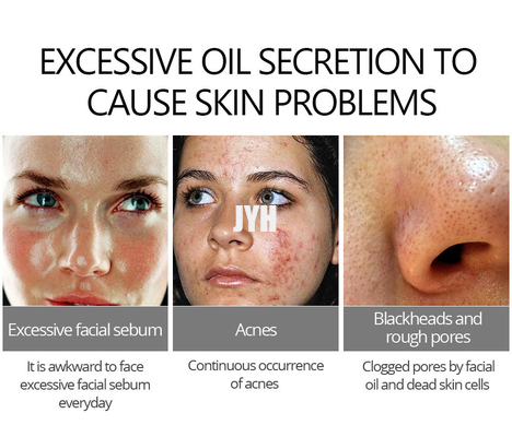 Gentle Skin Care Acne Treatment Cream 30g For Acne Prone Sensitive Skin